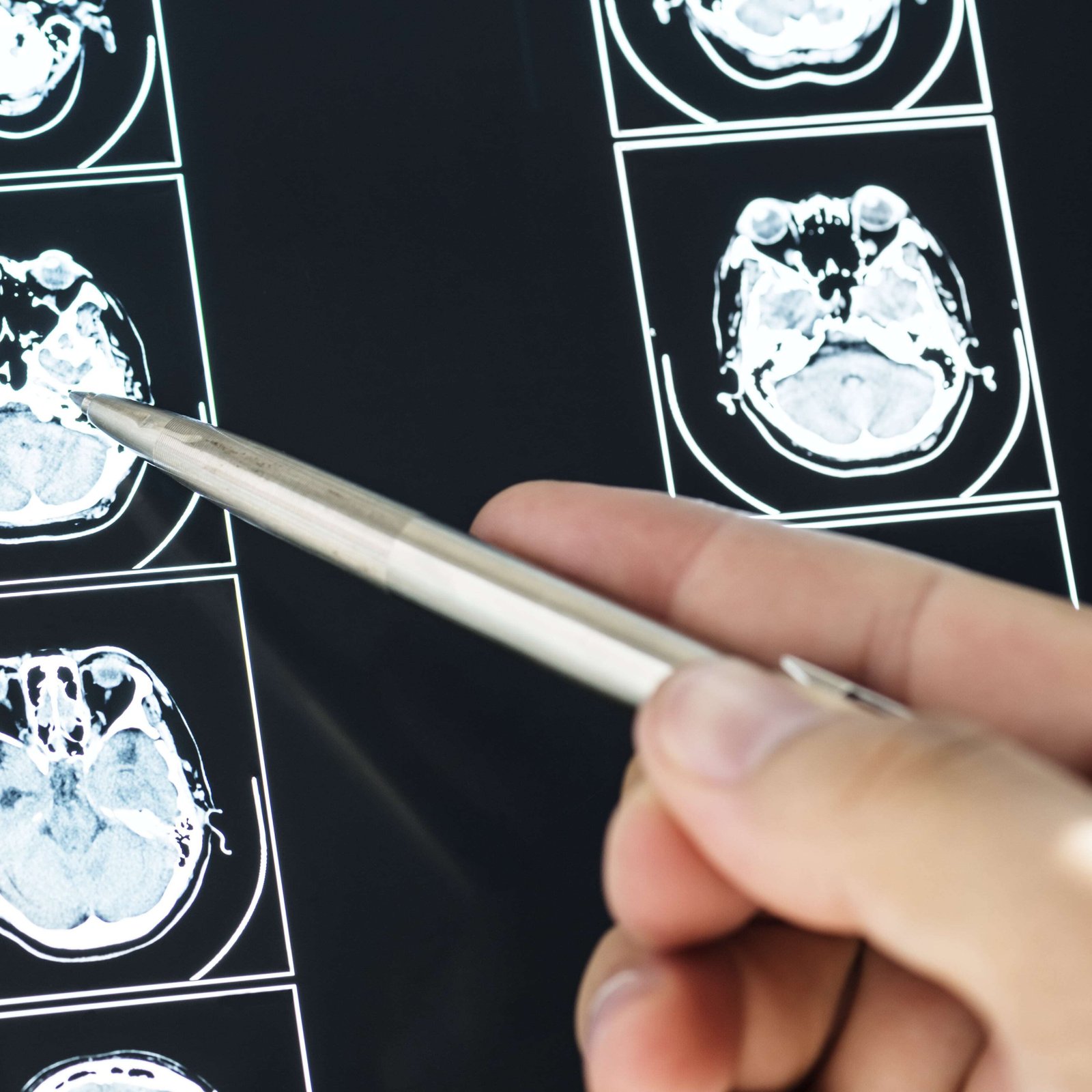 Fotografia de exame de ressonância magnética